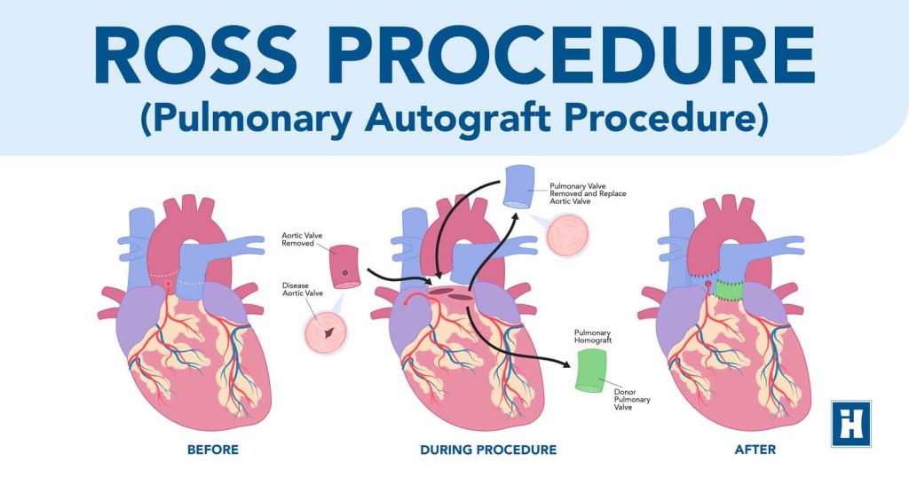 Infirmary Health Now Performing Ross Procedure