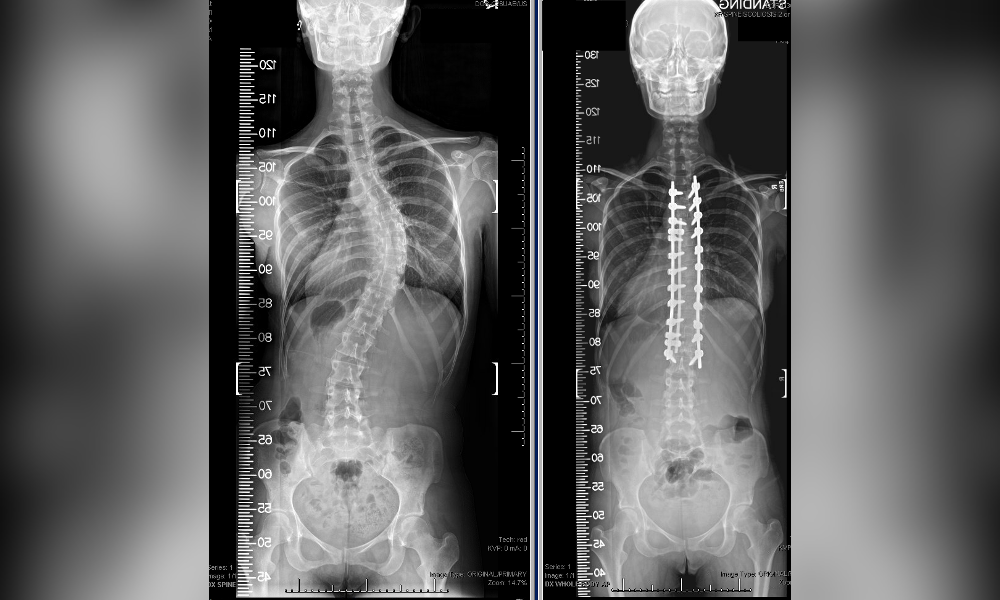 MENGER ACCEPTED INTP PREMIER SCOLIOSIS