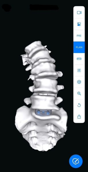 USA HEALTH OFFERING CUSTOMIZED SPINE SURGERY IMPLANTS