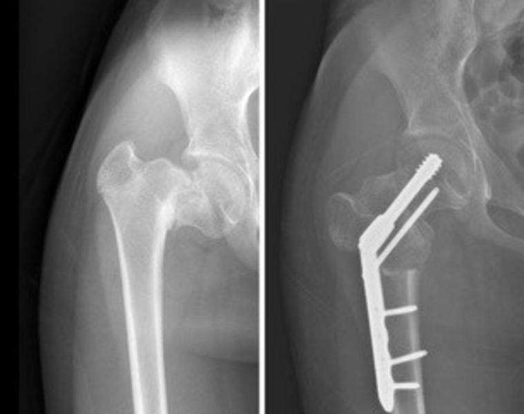 USA HEALTH PERFORMS FIRST-IN-STATE PEDIATRIC HIP IMPLANT PROCEDURE