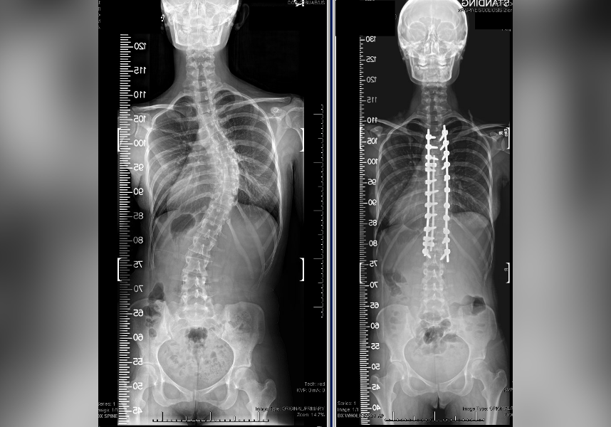 MENGER ACCEPTED INTP PREMIER SCOLIOSIS