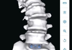 USA HEALTH OFFERING CUSTOMIZED SPINE SURGERY IMPLANTS