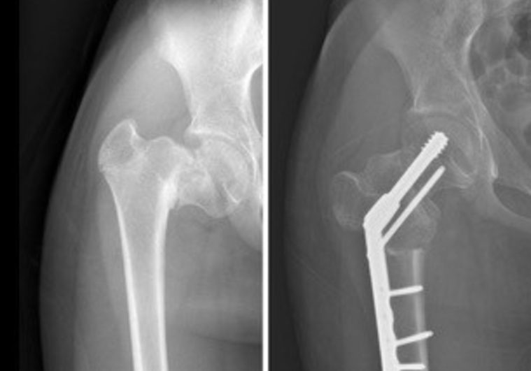 USA HEALTH PERFORMS FIRST-IN-STATE PEDIATRIC HIP IMPLANT PROCEDURE