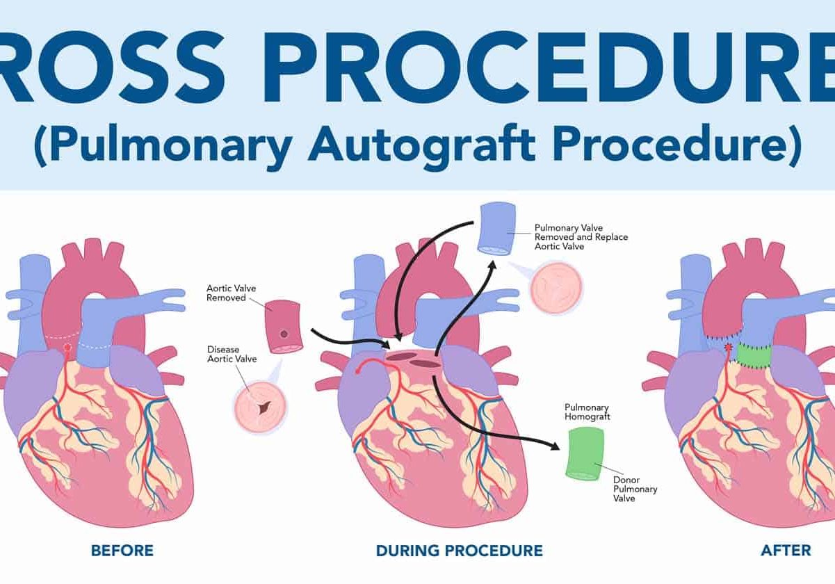 Infirmary Health Now Performing Ross Procedure